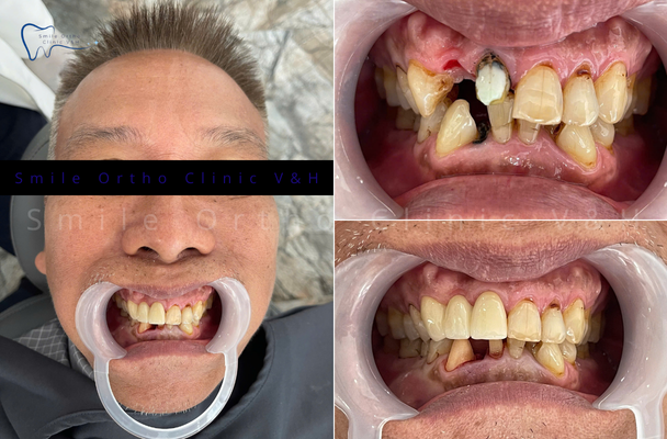 RĂNG SỨ ZIRCONIA 
